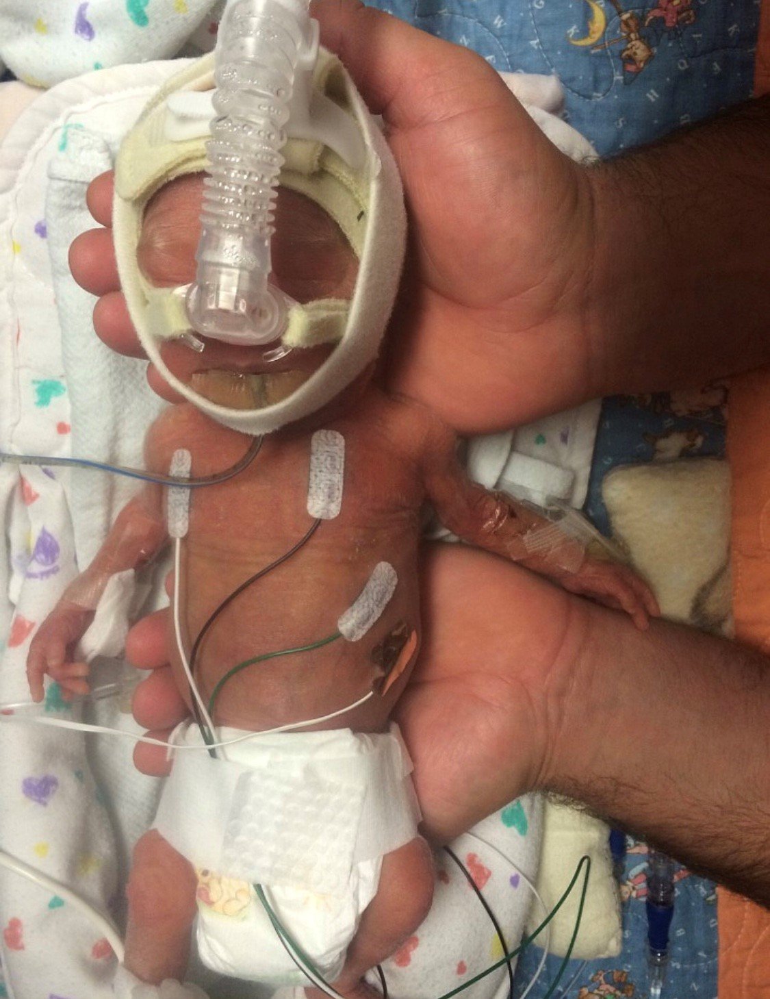 Premature baby hooked up to breathing machine