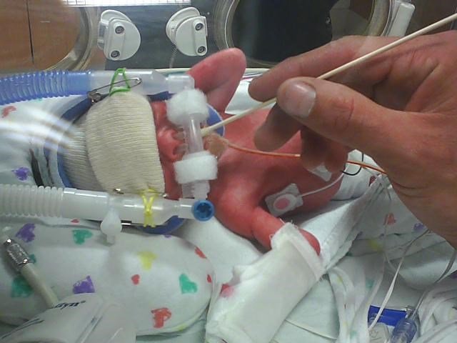 Premature baby receiving tube-fed donor milk