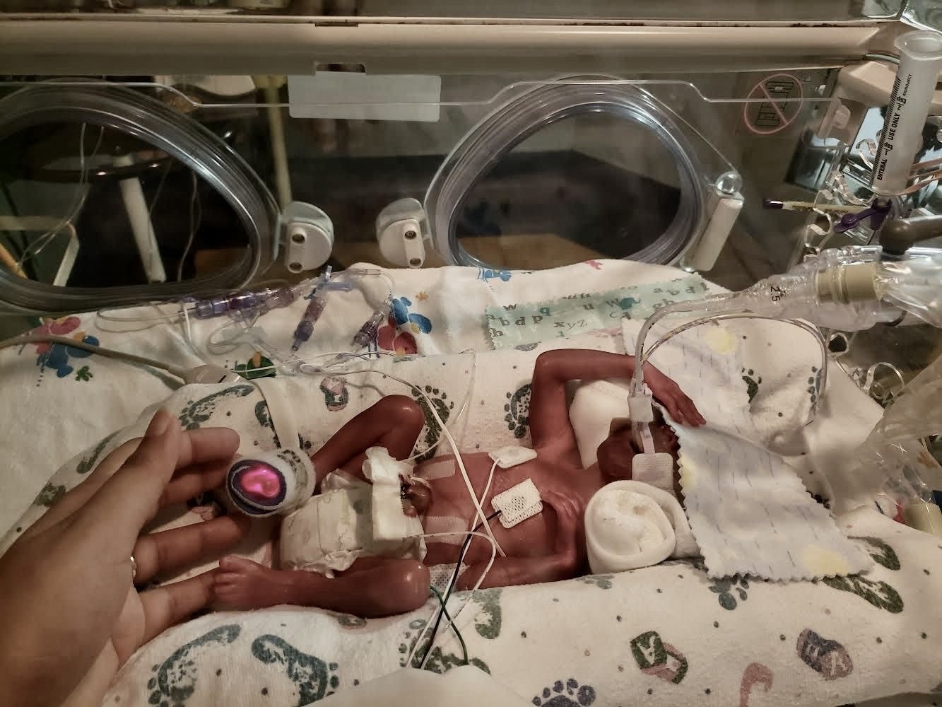 Saira's first baby, born at 24 weeks