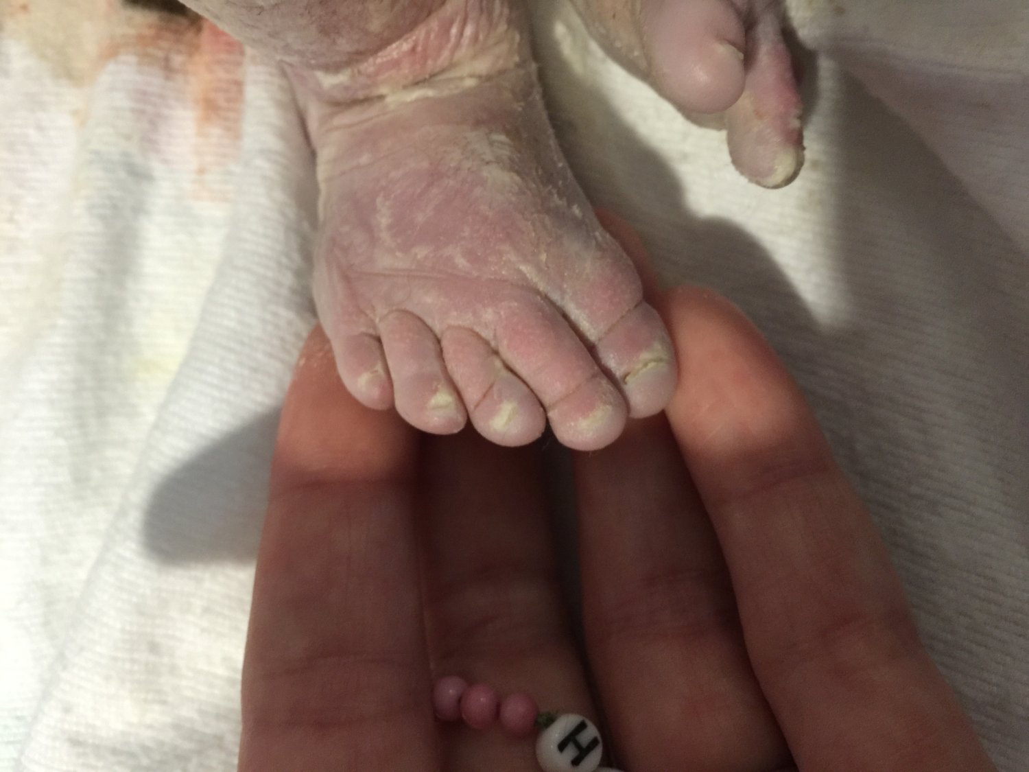 Foot of stillborn baby